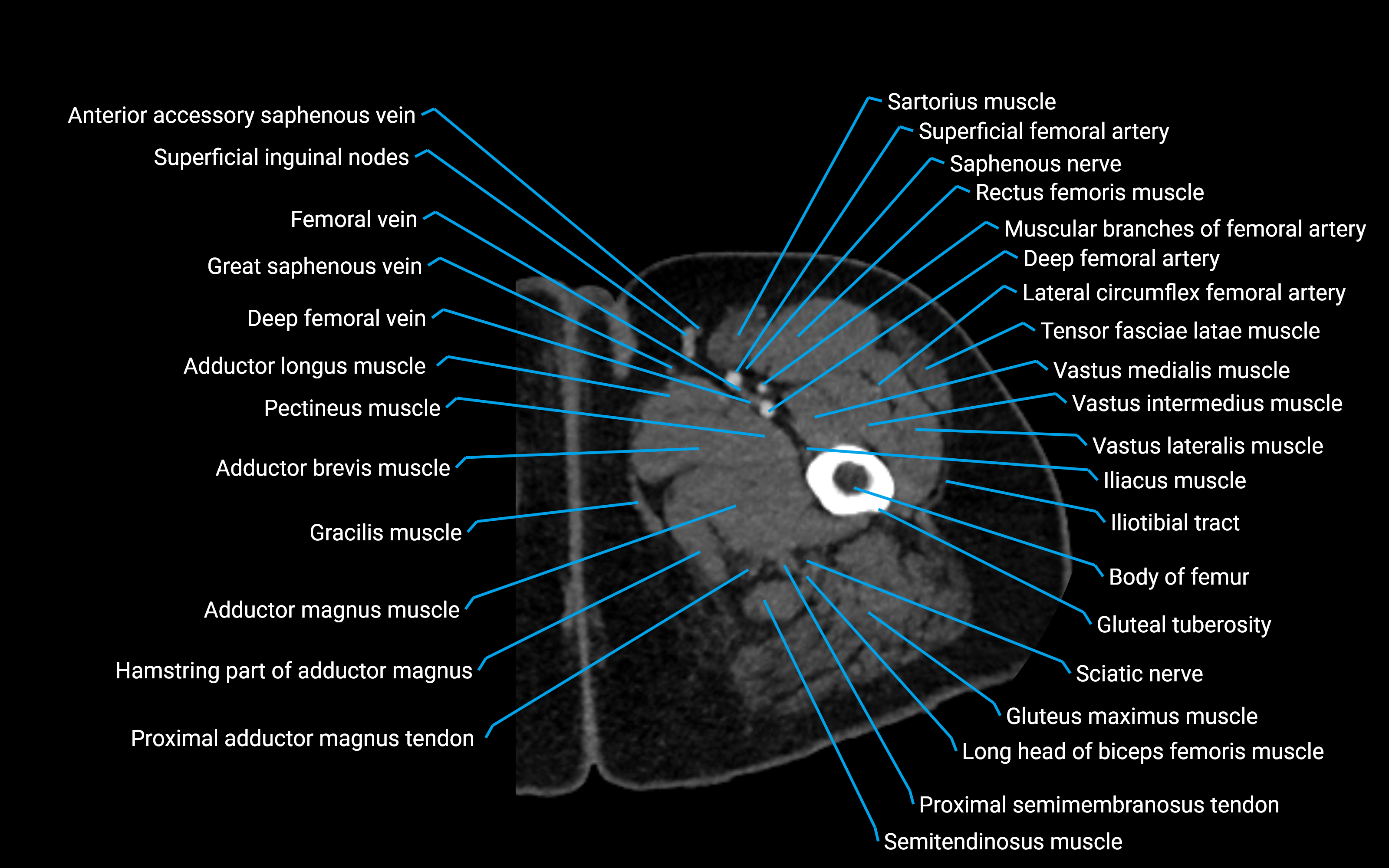 CT Hip axial cross sectional anatomy labelled image 22 (2).png